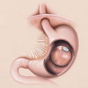 تقنية بالون المعدة  Gastric Balloon الحديثة