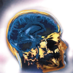 السكتة الدماغية...