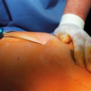 عملية شفط الدهون...