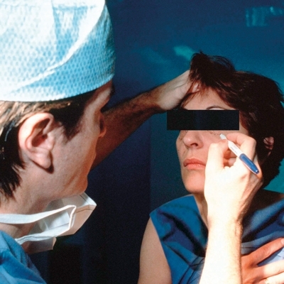 الجراحة التجميلية لشد الجفنين...