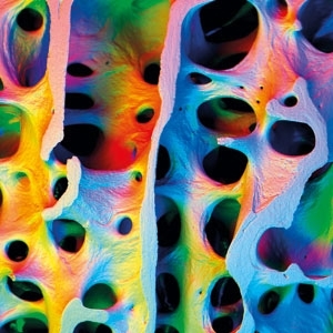 ترقق العظام