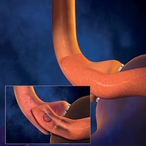 جراحة البدانة في تطوّر مستمرّ!