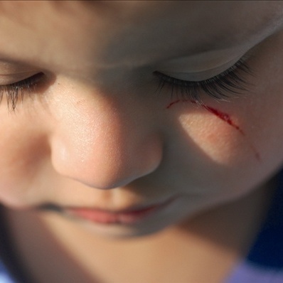 كيف تتعاملين مع إصابات طفلك؟