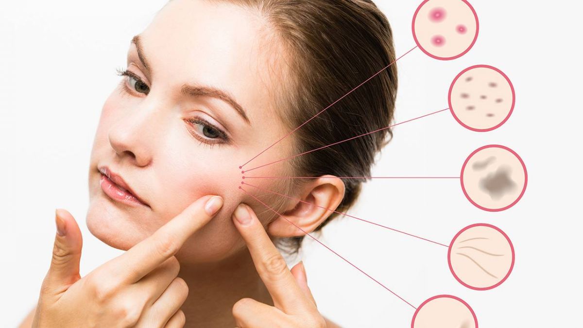 إليكِ التقنية السحرية لإخفاء البثور قبل العودة إلى المدرسة