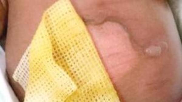 ممرضة تحرق رضيعاً في مستشفى بالسعودية.. وهذه عقوبتها