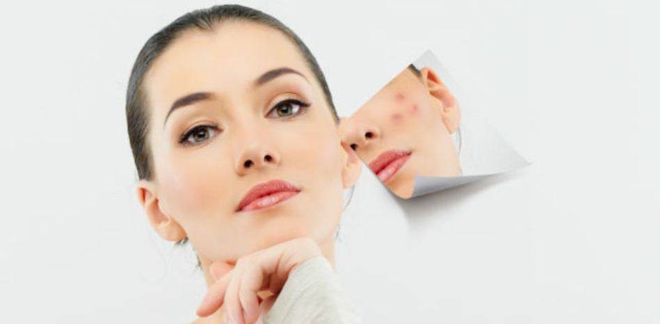 اكتشاف سبب مجهول لظهور حب الشباب... قد تكونون من ضحاياه