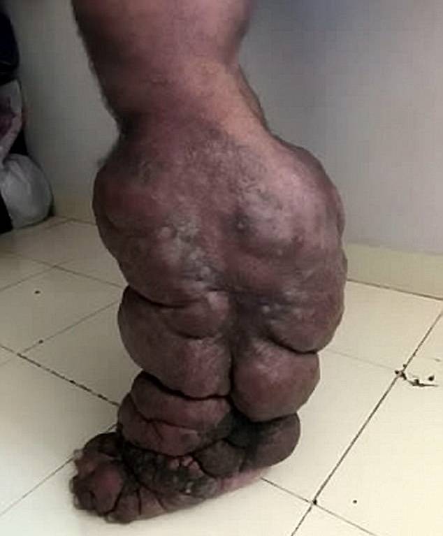بسبب لسعة بعوض أصبحت ساق هذا الرجل هكذا