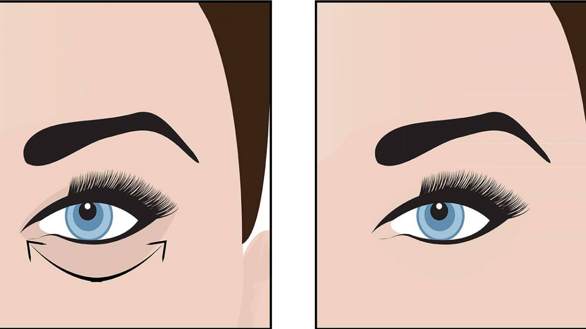 الحلّ السحري للتخلص من انتفاخات الجفون... وصفة منزلية