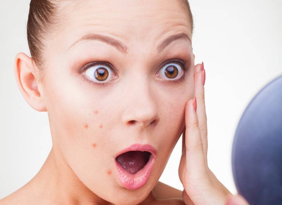 لن تصدّقي – البوتوكس لعلاج حبّ الشباب أيضاً... هذا ما يجب أن تعرفيه