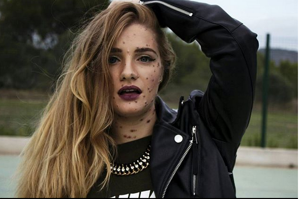 أخفاها والدها خجلاَ من شكلها الغريب... إكتشفوا كيف تحدّت مرضها وحققت الشهرة