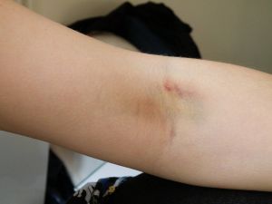 لا تتهاونوا مع هذه الكدمات فهي تعني الكثير.. اليكم الجواب