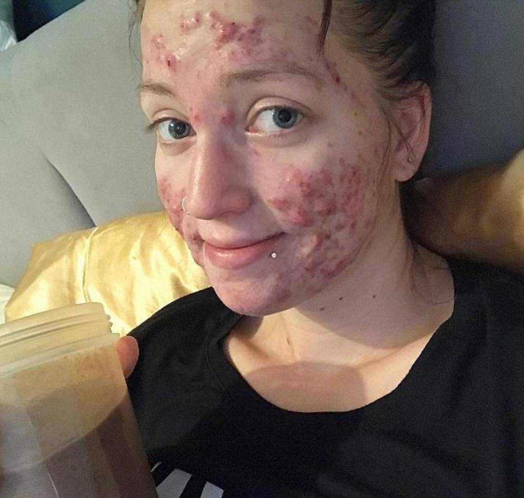 بالصور – شابة تتعرّض للتشوه بسبب نوع نادر من حبّ الشباب... 