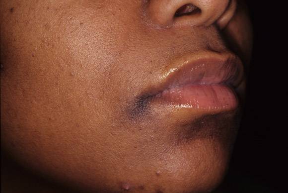 4 وصفات منزلية للتخلص من زوايا الفم الداكنة