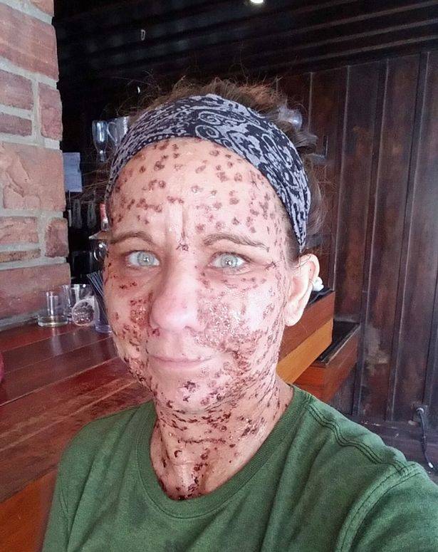 بالصور - سخروا منها ولقبوها بالسحلية... شاهدوا كيف تخلصت هذه المرأة من التشوه بسبب آلاف الأورام