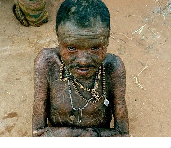 بالصور - هل تتذكرون الرجل الشجرة؟ تعرفوا الآن إلى الرجل الذي يبدل جلده كالأفعى