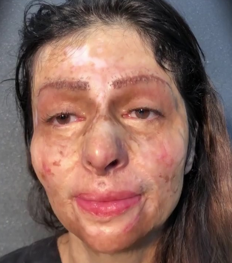 بالفيديو - وضعوا المكياج على وجهها المحروق... التحوّل مذهل وردّة فعلها تفطر القلوب