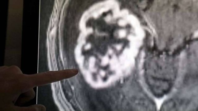 مرض صادم بالصور - سرطان في رأس رجل من الحيوانات المنوية