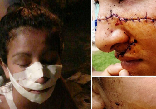 بسبب الغيرة من جمالها فتاة تتعرض للتشويه بأبشع الطرق... هكذا دمرت حياتها