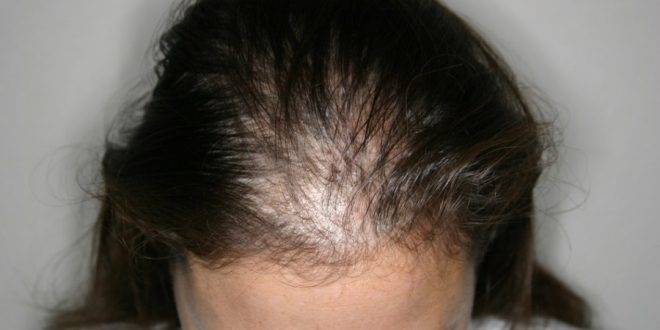 لحماية الشعر ومنع الصلع.. أكثروا من تناول هذا المكون