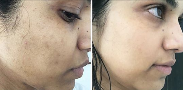 التخلص من البقع السوداء والداكنة بوصفات سهلة وسريعة