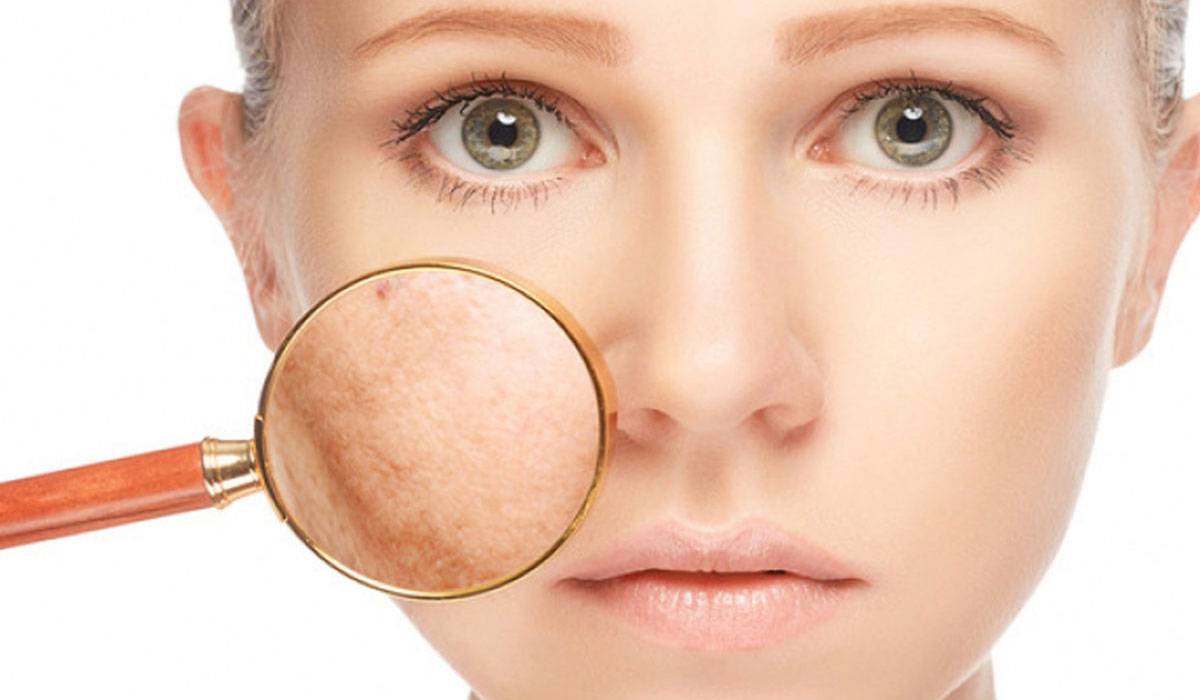 وصفة لإزالة الكلف من الوجه