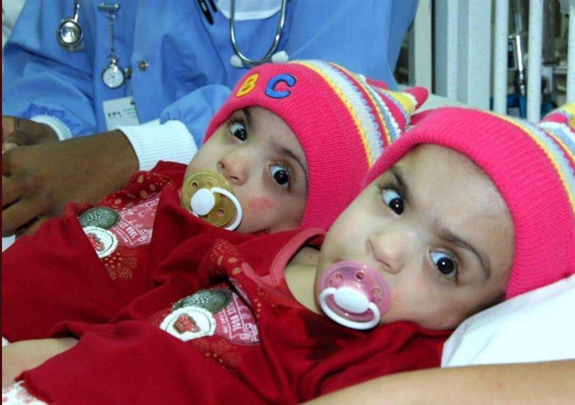 هل تذكرون التوأم الخليجي الملتصق صفاء ومروة... هكذا أصبحتا بعد 11 عاماً