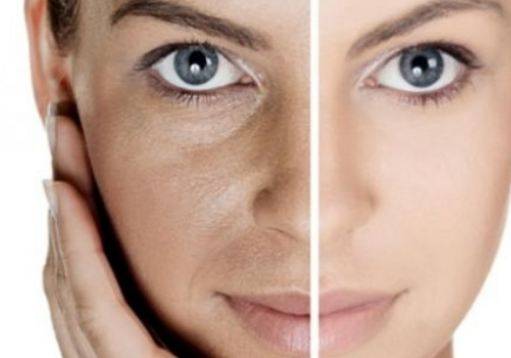 إزالة الكلف من الوجه نهائياً