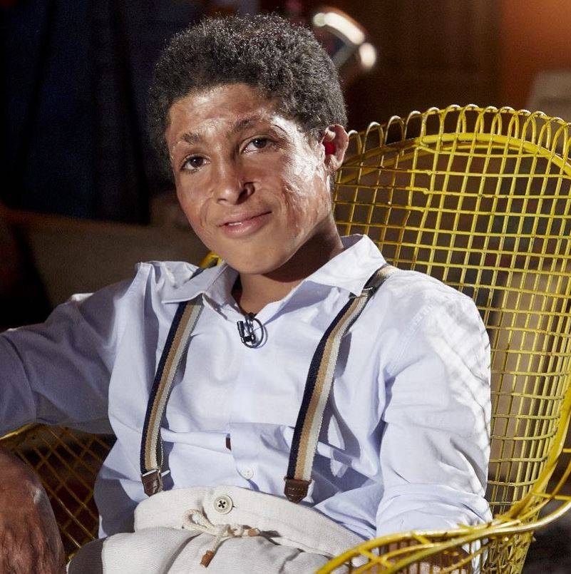 بعد احتراق وجهه... طفل يروي تفاصيل الجريمة التي ارتكبتها عمته