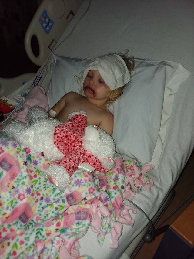 بالصور - بسبب لعبة تشترونها لبناتكم... طفلة تتعرض للتشوه في وجهها والأم تحذر