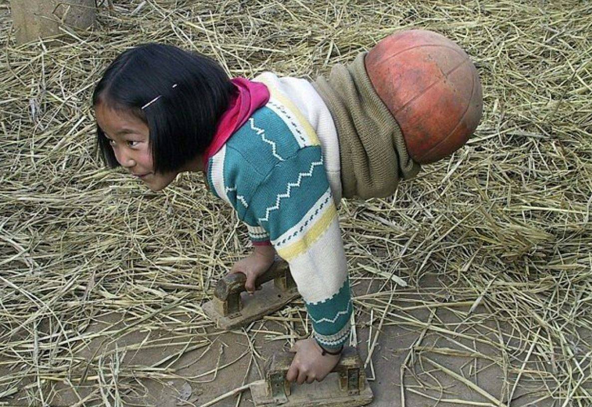 هل تتذكرون الطفلة مبتورة القدمين التي تتنتقل بواسطة كرة؟ لن تتخيلوا كيف أصبحت