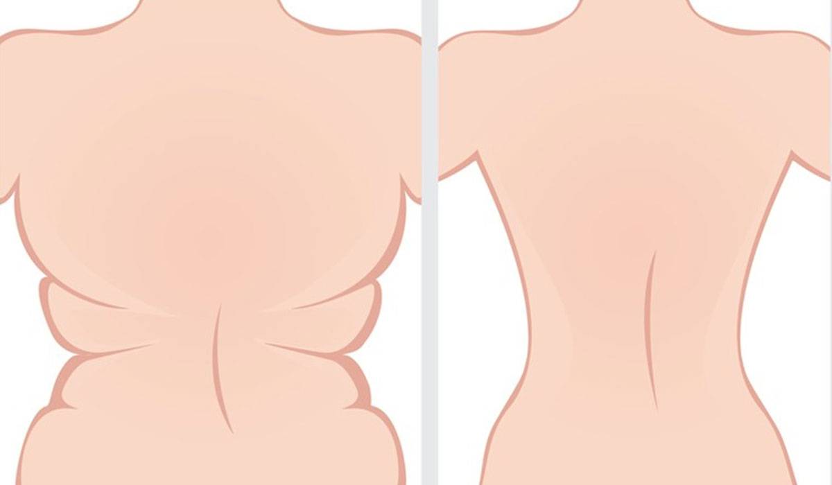 طرق بسيطة وفعالة للتخلص من دهون الظهر