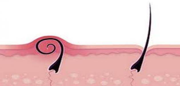 اليك أبسط الطرق للتخلص من الشعر المزعج تحت الجلد