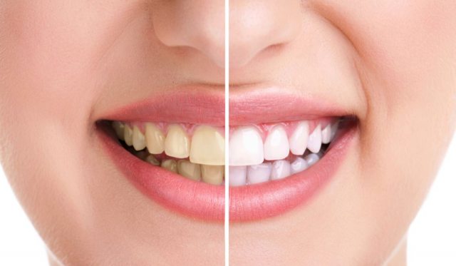 أسباب اصفرار الأسنان كثيرة... ما علاقة التقدم في العمر؟