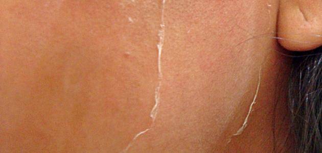 كيف تعالجين حروق البشرة بخلطات طبيعية؟