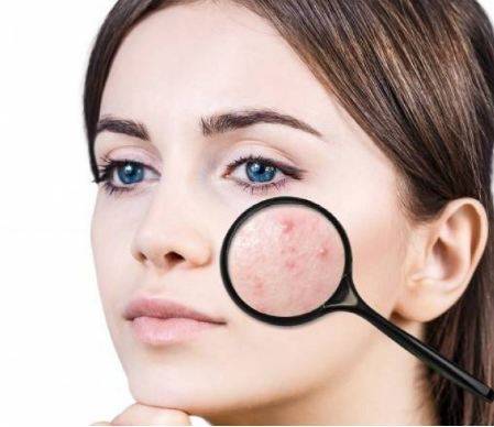 أسباب غير متوقعة لحبّ الشباب!