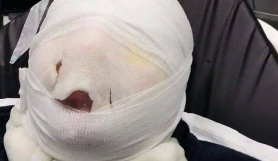 هذه الطريقة في سلق البيض أحرقت وجه هذا الرجل... لا تستخدميها