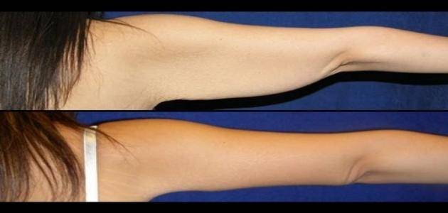 للتخلص من ترهلات الذراعين إليك الخطوات.. سهلة وبسيطة