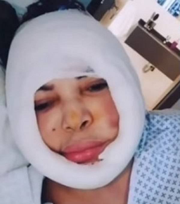 بالصورة – فلّة تكشف ما حدث لوجهها وأدى إلى نقلها إلى المستشفى... وهكذا بدت من دون ضمادات