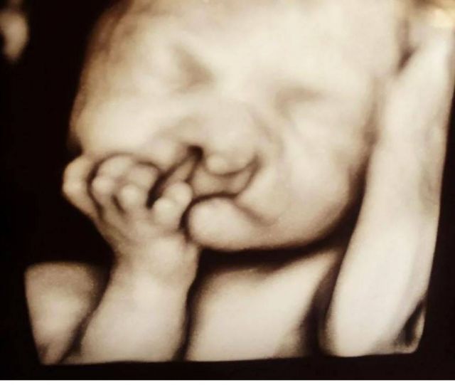 صورة لأصحاب القلوب القوية – رفضت الإجهاض رغم تشوه الجنين... شاهدوه بعد ولادته