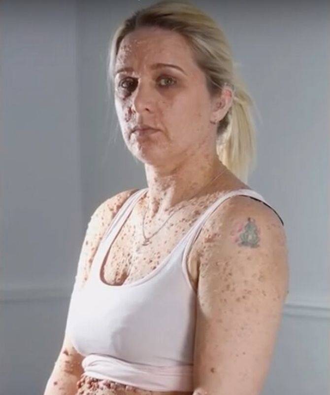 لم تروا هذا من قبل- مئات البثور تغطّي بشرتها... هذه تفاصيل مرضها ومعاناتها من نظرة الآخرين