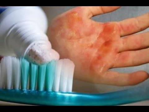 وضعت معجون الأسنان على يدها بعد احتراقها.. والنتيجة كارثية