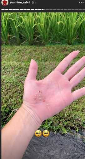 ياسمين صبري توضح إصابة يدها