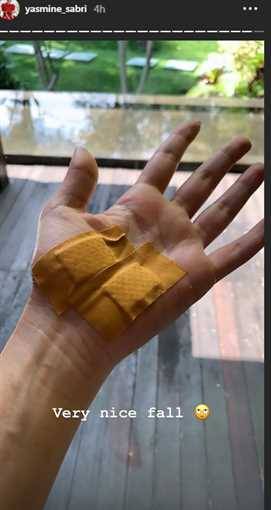 يد ياسمين صبري بعد العلاج