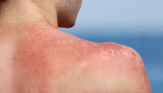 حروق الشمس لدى الرجال: خطرٌ يُهدّد البشرة