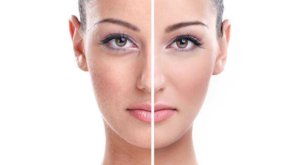 مكون واحد يخلص البشرة من الرؤوس السوداء والبثور والشوائب... تعرفوا اليه