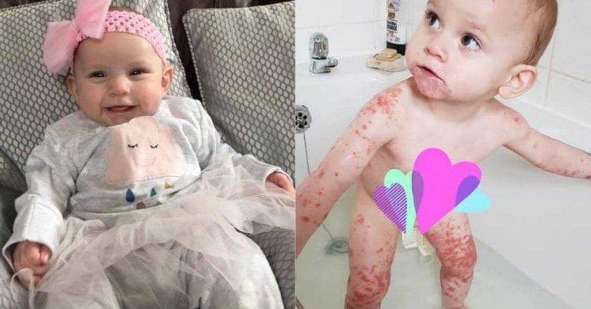 لا تدعوا احداً يقبل وجوه أطفالكم... ما حدث لهذه الطفلة غير متوقع