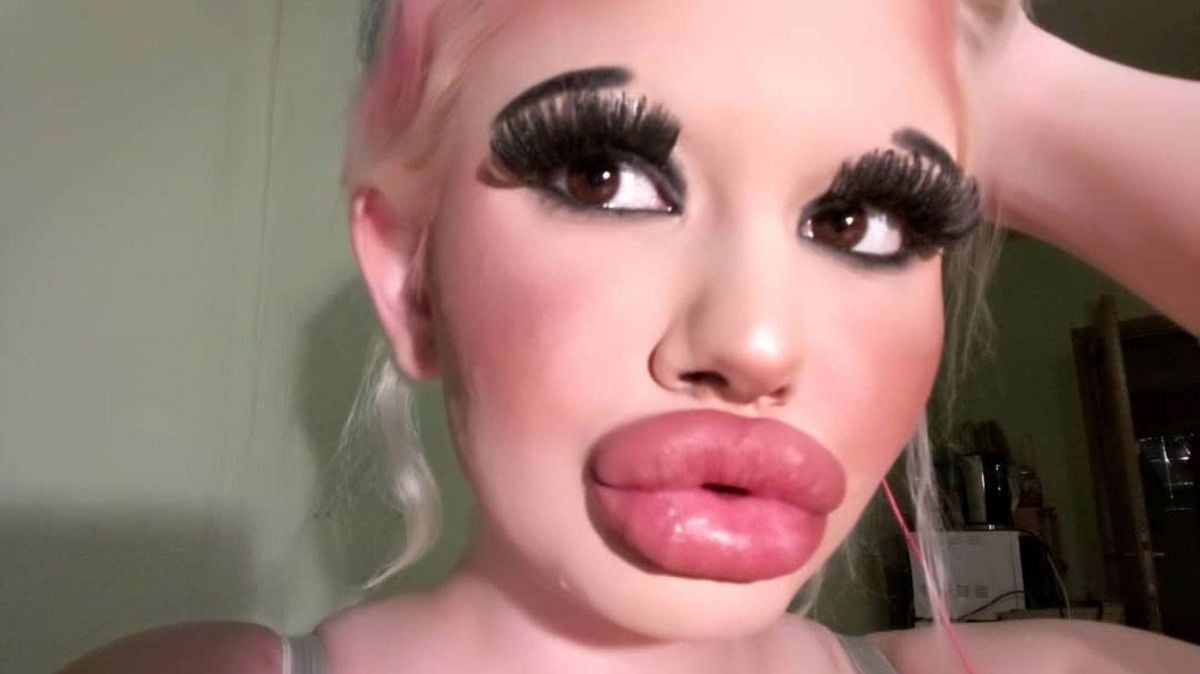 إليكم ما فعلته هذه الفتاة لتصبح شفتاها بهذا الشكل الغريب