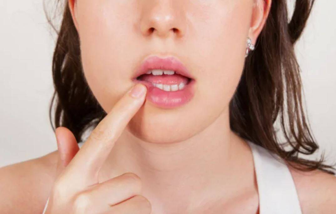 طريقة سهلة جداً للتخلص من بثور الحمى منذ اليوم التالي... ما قصة العسل؟