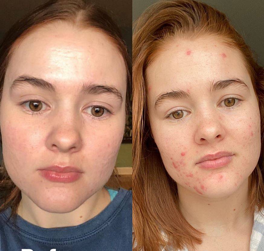 بالصور - تعرضت لسخرية لاذعة بسبب شكل وجهها... هكذا تحدت الجميع واستعادت جمالها