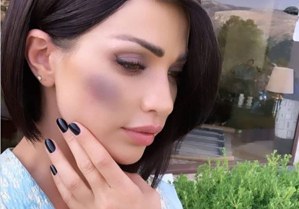 بالصور - سبب ظهور داليدا خليل بأثار ضرب على وجهها!